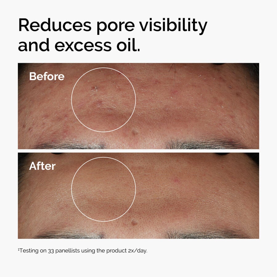niacinamide-10-zinc-1-z6 ord-niacinamide-zinc-blemish-serum-before-after-pores.jpg