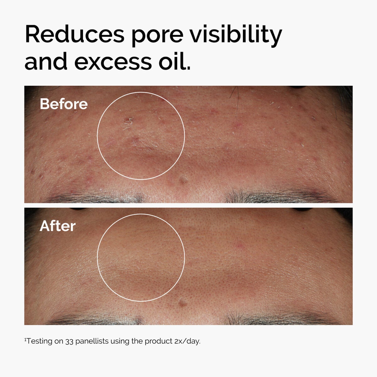 niacinamide-10-zinc-1-z6 ord-niacinamide-zinc-blemish-serum-before-after-pores.jpg