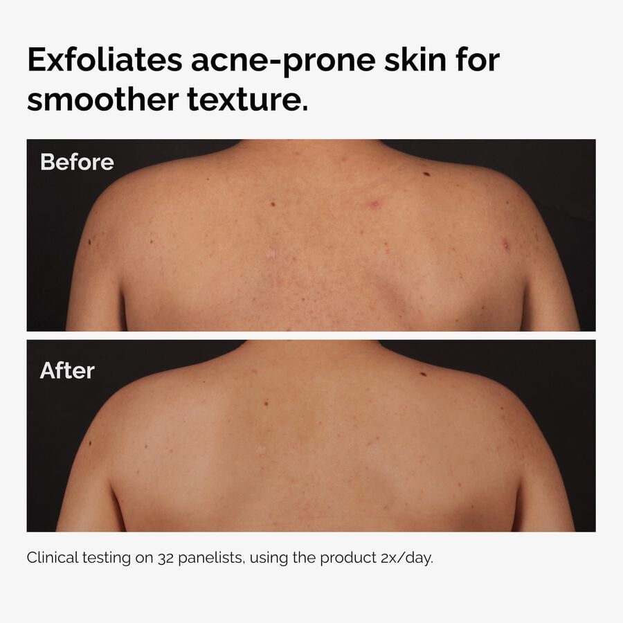 the-body-care-collection-z2 ord-salicylic-acid-body-serum-before-after-graphic-NA.jpg