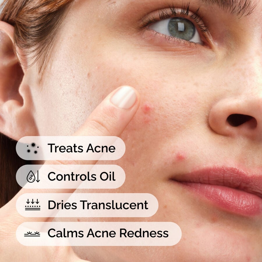 sulfur-10-powder-to-cream-concentrate-s0 ord-sulfur-10pct-powder-to-cream-concentrate-model-application-with-benefits-acne.jpg